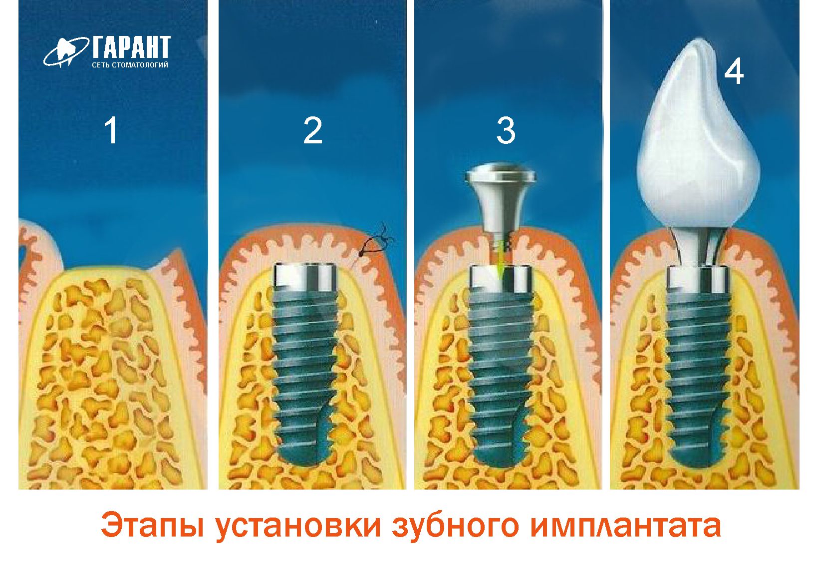 Этапы имплантации зубов абатмент